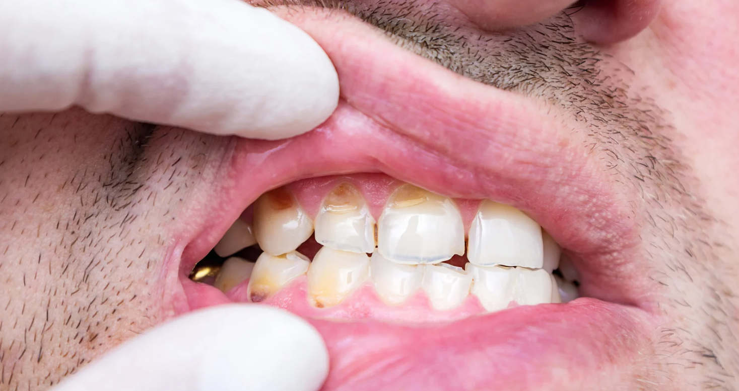 Cracked tooth assessment at Grafton Smiles, North Grafton MA