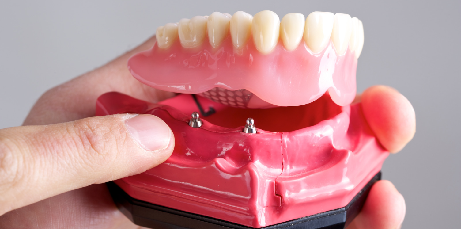 Implant retained dentures at Grafton Smiles, North Grafton MA