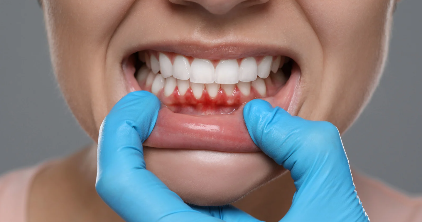 Bleeding gums assessment at Grafton Smiles, North Grafton MA