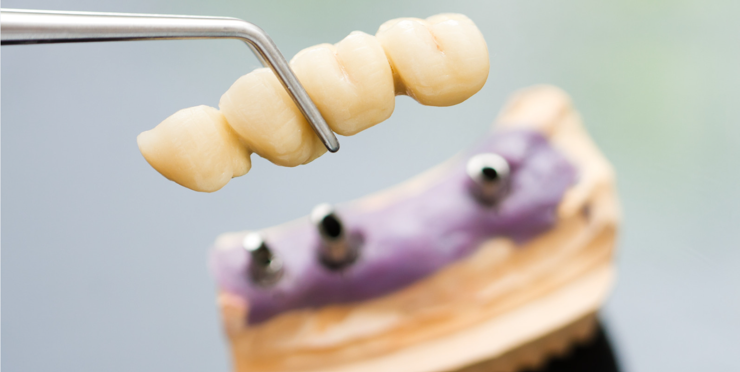 Dental bridges at Grafton Smiles, North Grafton MA