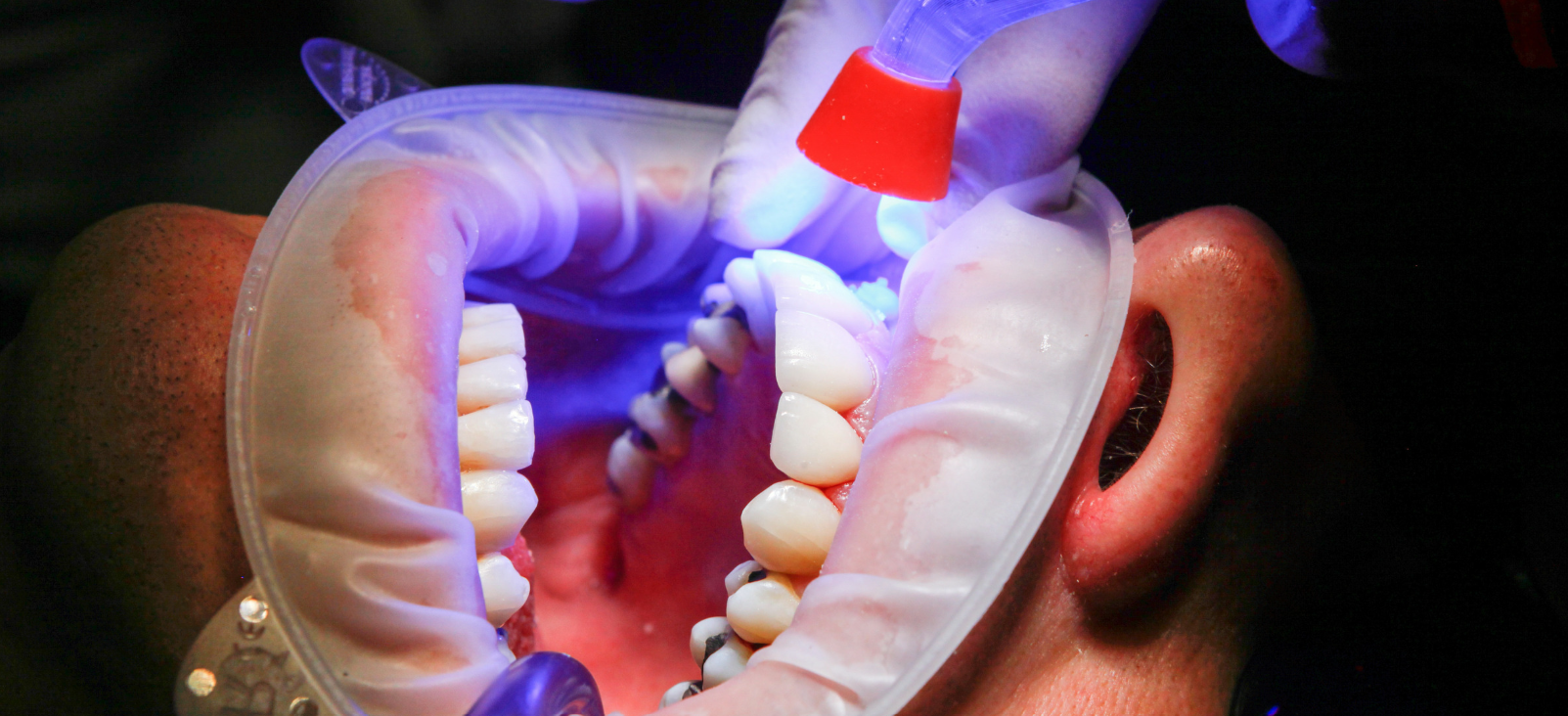 Tooth-colored fillings at Grafton Smiles, North Grafton MA