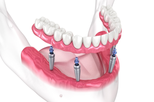 All-on-4 dental implants at Grafton Smiles