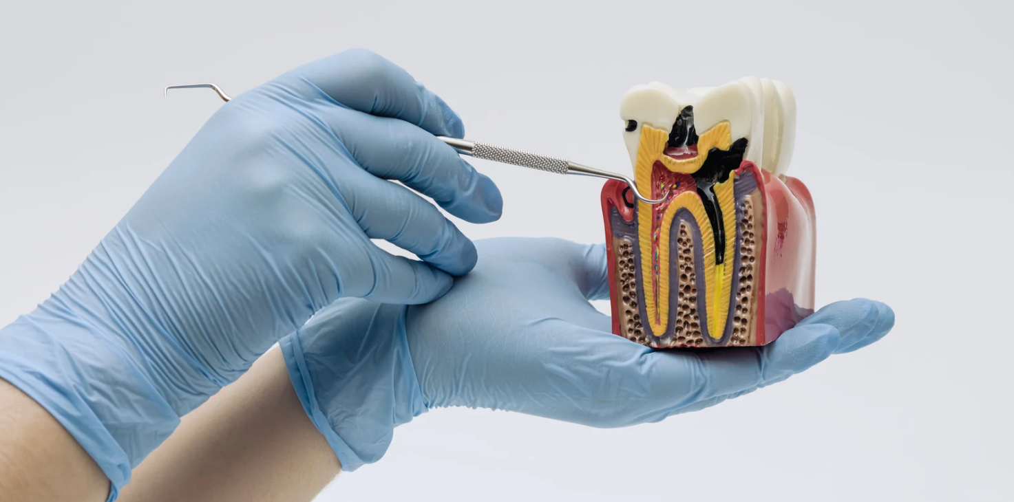 Root canal treatment at Grafton Smiles, North Grafton MA