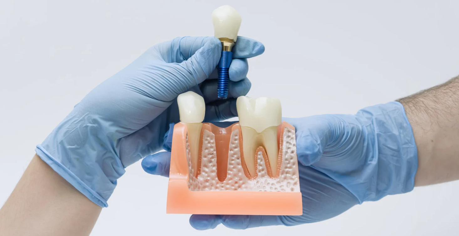Single tooth implant at Grafton Smiles, North Grafton MA