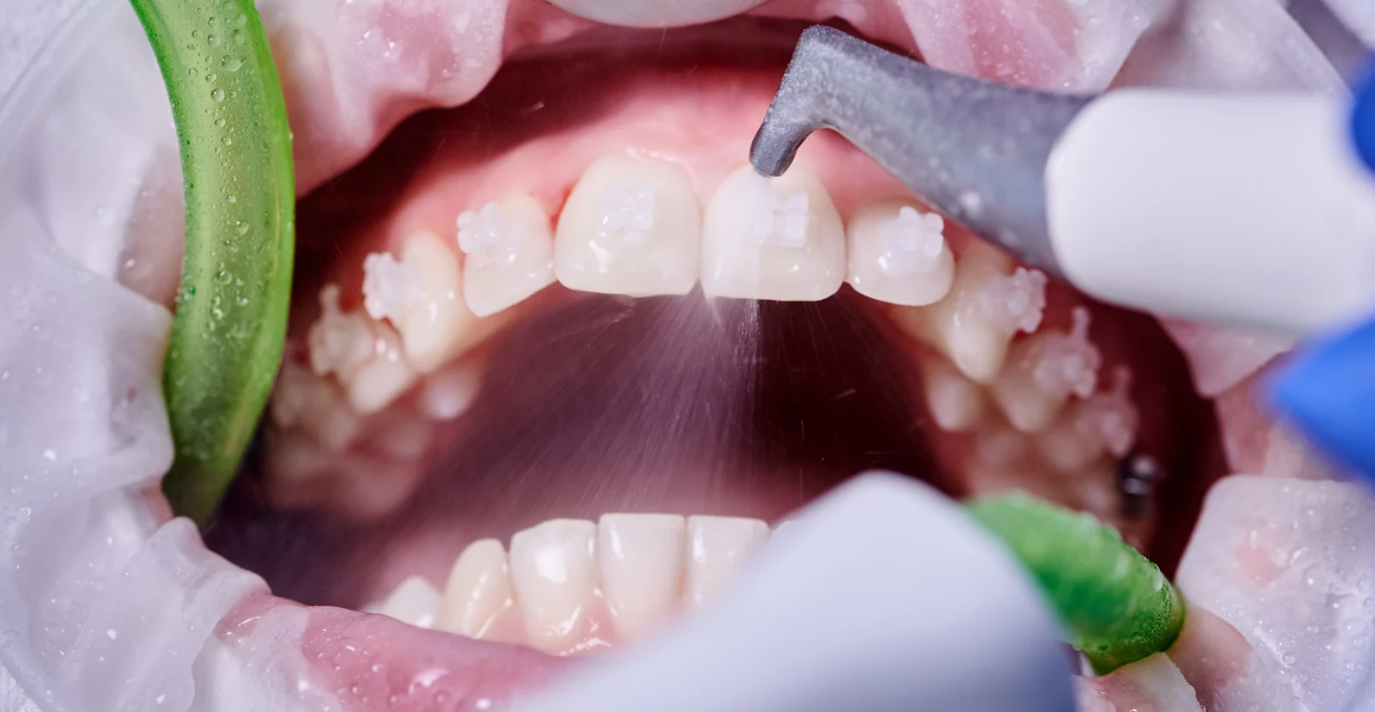 Teeth cleaning at Grafton Smiles, North Grafton MA