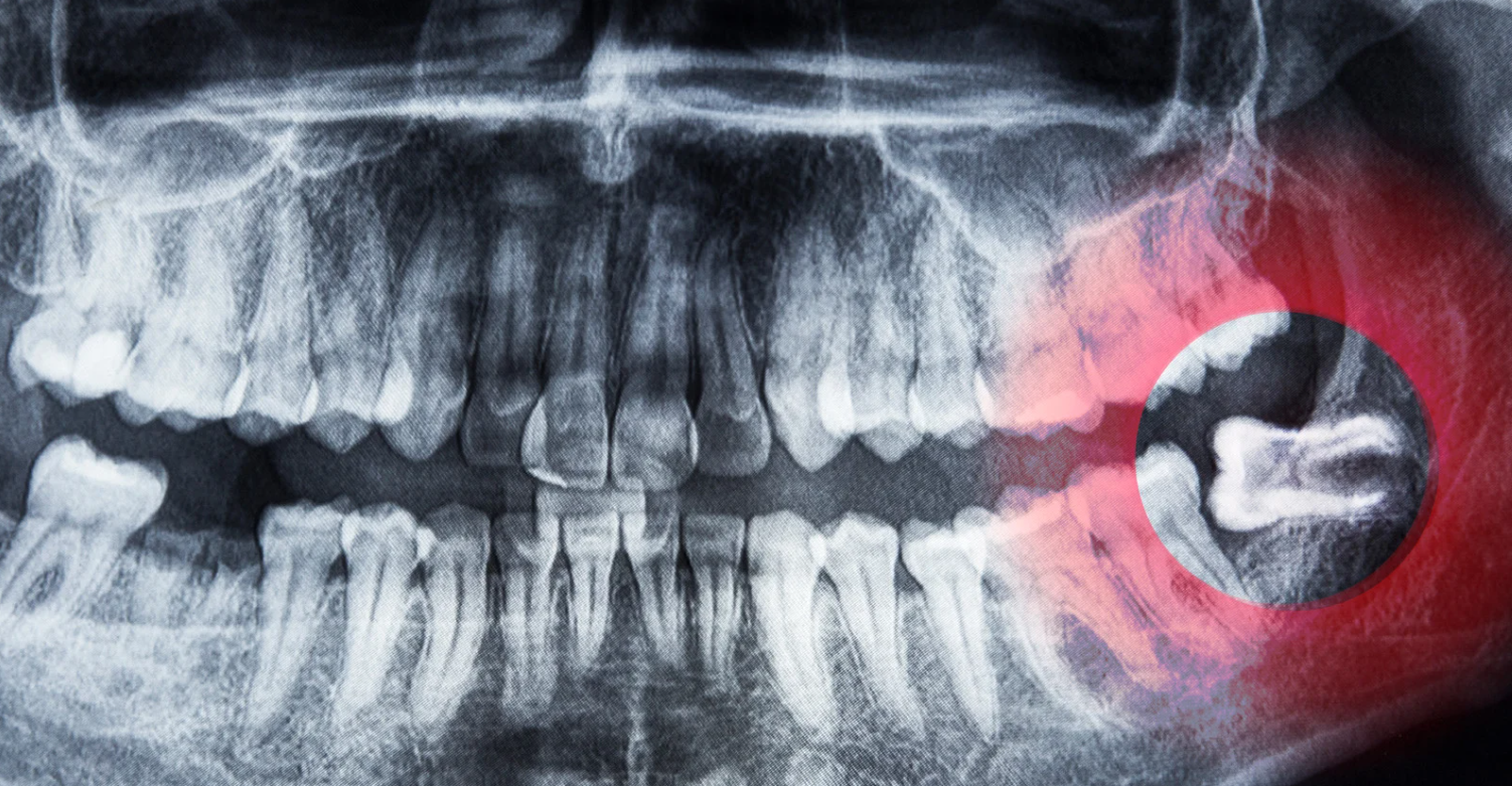 Wisdom teeth assessment at Grafton Smiles, North Grafton MA