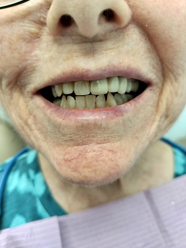 Up-close image of a smiling woman missing one tooth after dental implants