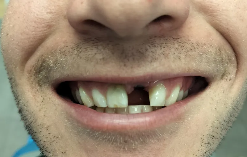 Up-close image of a man with one missing front tooth