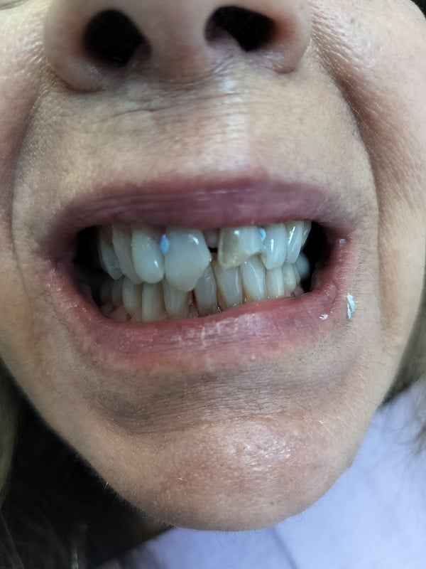 Up-close image of a woman with broken front teeth