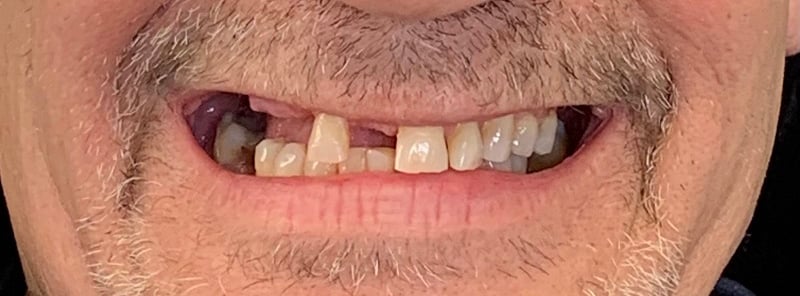 Up-close image of a man with multiple missing upper and lower teeth