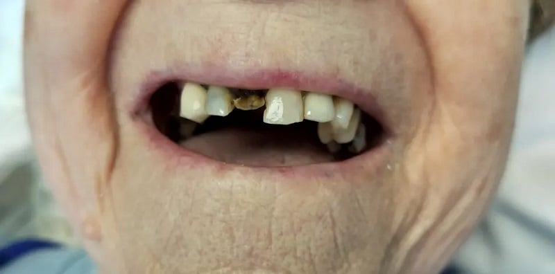 Up-close image before dental implants