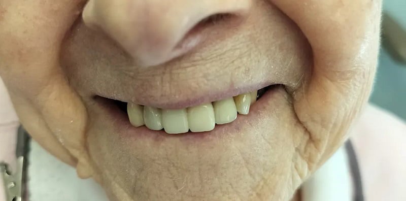 Up-close image after dental implants