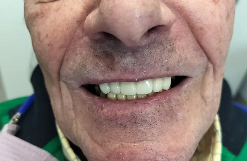 Up-close image after dental implants
