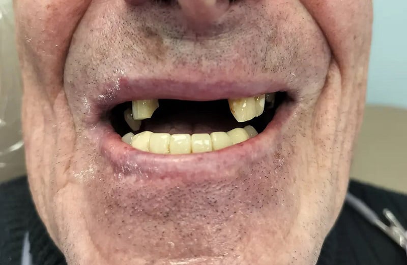 Up-close image of a man missing upper teeth before dental implants