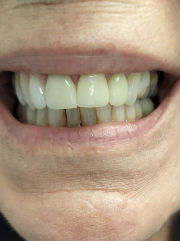 Up-close image of a woman after broken front teeth were fixed