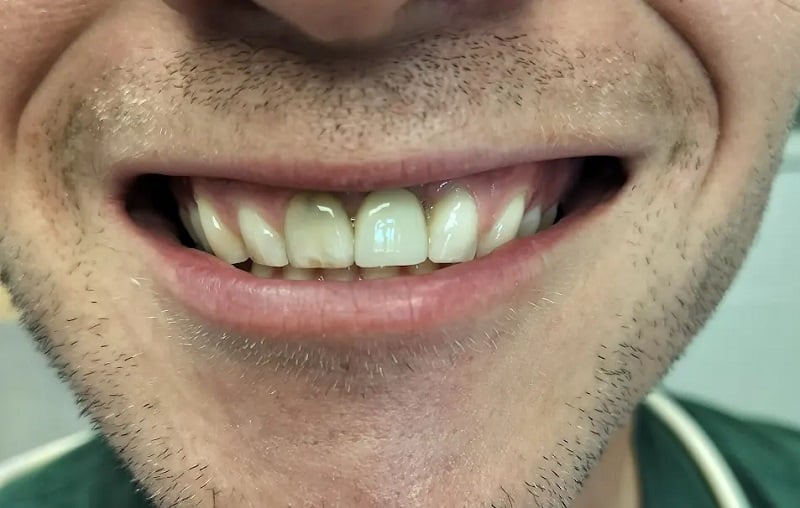 Up-close image of a man with one missing front tooth fixed with dental implant