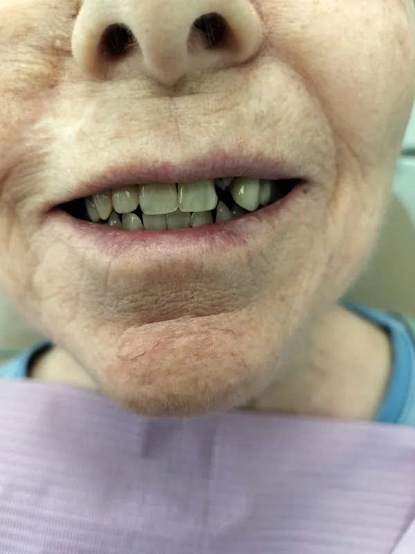 Up-close image of a smiling woman missing one tooth before dental implants