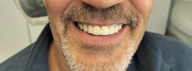 Up-close image of a man with previously multiple missing upper and lower teeth, fixed with dental implants