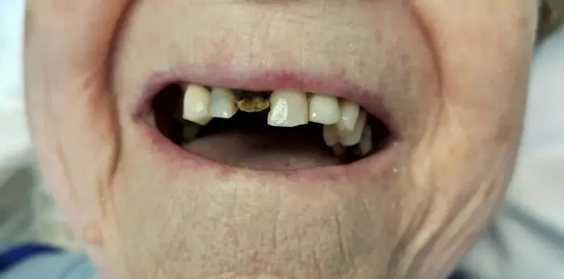 Up-close image before dental implants