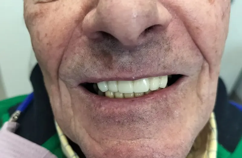 Up-close image after dental implants