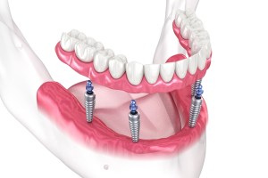 all on 4 dental implants